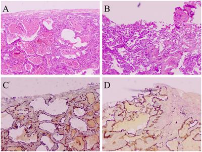 Diagnosis, treatment, and prognosis of stage IB non-small cell lung cancer with visceral pleural invasion